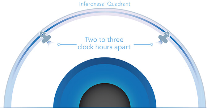 The inferonasal-quadrant showing two Glaukos trabecular micro-bypass stents are placed two to three clock hours apart.