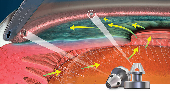 iStent inject® Trabecular Micro-Bypass Instertion illustration.