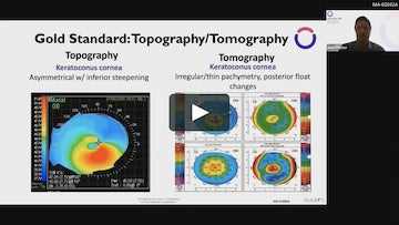 Co-Management of the Keratoconus Patient Webinar video by Jack Parker, MD & Mitch Ibach, OD.