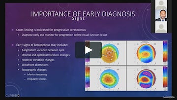 ICON OD Webinar on Corneal Cross-Linking video by Jay Arora, MD & Eva Kim, MD.