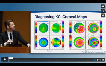 Keratoconus: What You Need to Know - Diagnostics, Cross-Linking, and Scleral Lenses video by John Gelles, OD, 2020 GSLS.