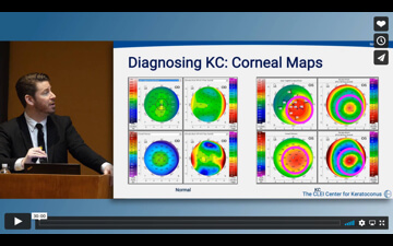 Keratoconus: What You Need to Know - Diagnostics, Cross-Linking, and Scleral Lenses video by John Gelles, OD, 2020 GSLS.