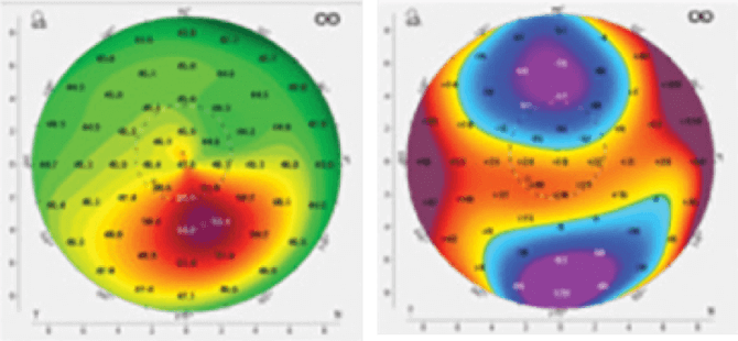 Patient with Keratoconus.