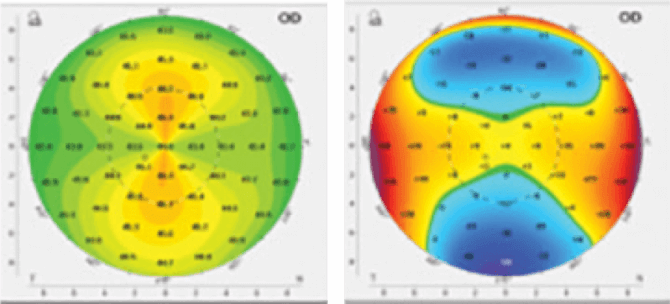 Patient with normal astigmatism.