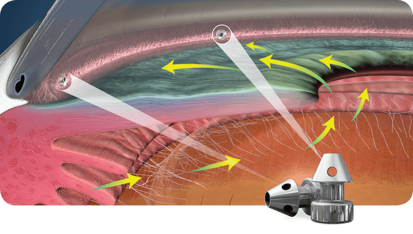 iStent inject ® Trabecular Micro-Bypass Insertion illustration.
